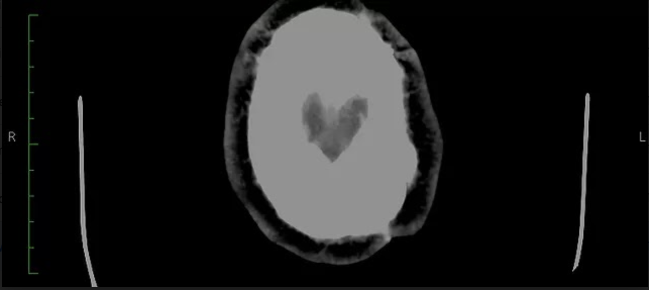 Brain injury recovery (TBI One Love podcast interview) Brain injury recovery (TBI One Love podcast interview)